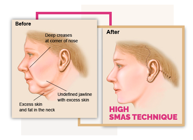 High SMAS Procedure